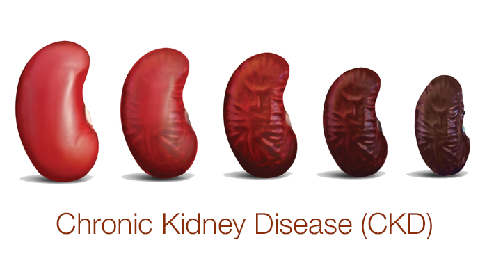 Causes of Chronic Kidney Disease